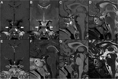 Neuroimaging of pediatric tumors of the sellar region—A review in light of the 2021 WHO classification of tumors of the central nervous system